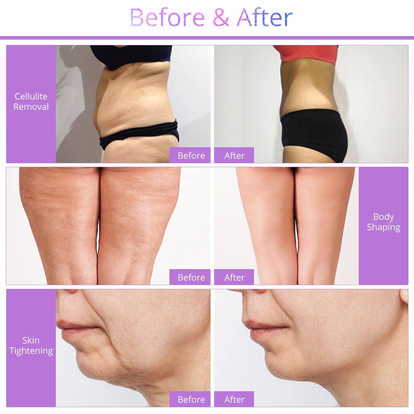 Elite 6 Attachments Beauty Machine for Boost Skin Firmness & Enhance Body Line